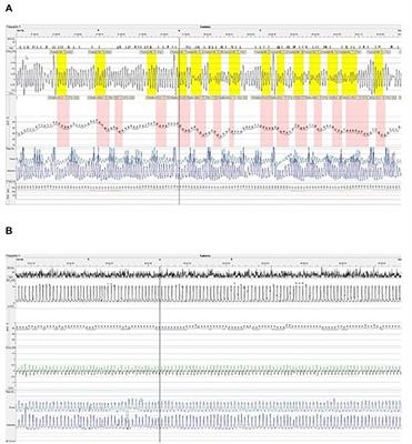 Long term NIV in an infant with Hallermann-Streiff syndrome: A case report and overview of respiratory morbidity